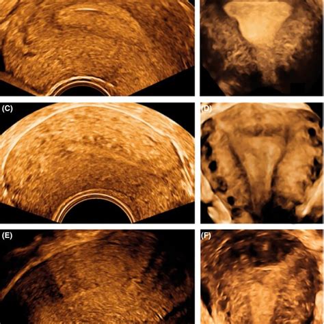 Two‐ And Three‐dimensional Transvaginal Ultrasonography Of The Uterus