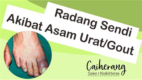 Asam Urat Hiperurisemia Dan Penyakit Gout Patofisiologi Gejala