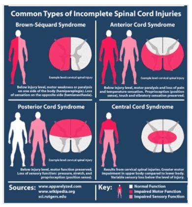 Posterior Cord Syndrome