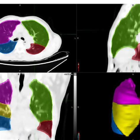 Example Of Lung Lobe Contours From Our 2d 3d Segmentation Network Download Scientific Diagram