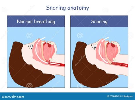 Snoring Anatomy Normal Breathing And Snoring Stock Vector