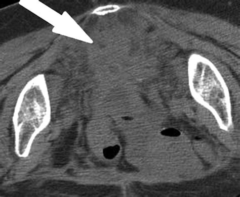 Evaluation Of Imaging Guided Core Biopsy Of Pelvic Masses Ajr