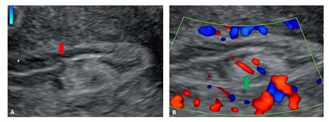 Transvaginal Sonographic Diagnosis Of An Endometrial Polyp Causing