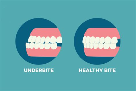 Do You Have An Underbite See If Invisalign Can Fix An Underbite