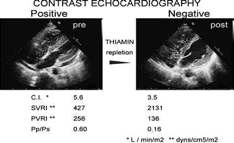 A Case With Beriberi Heart Inducible And Reversible Intrapulmonary