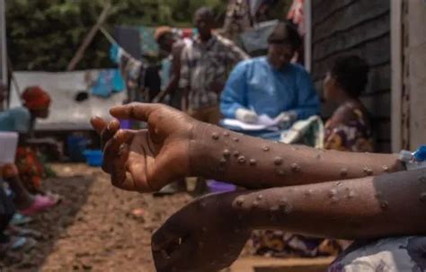 África ONU Alerta Sobre Aumento De Casos De Mpox TeleSUR