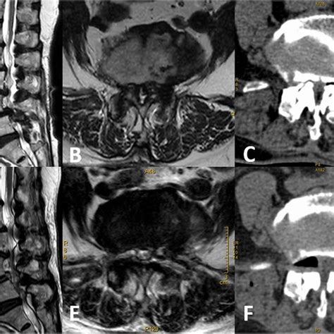 A B Central Spinal Stenosis Of L4 5 Was Shown In The Preoperative Mri Download Scientific