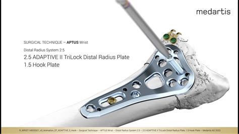 Surgical Technique Animation 2 5 Adaptive Ii Trilock Distal Radius