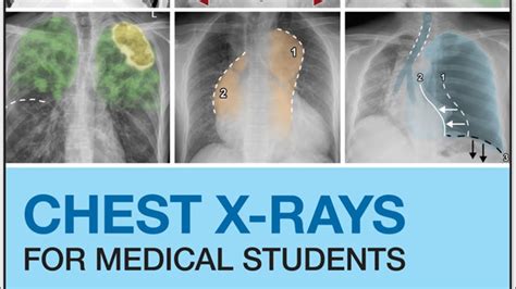 How To Read Chest X Ray Youtube