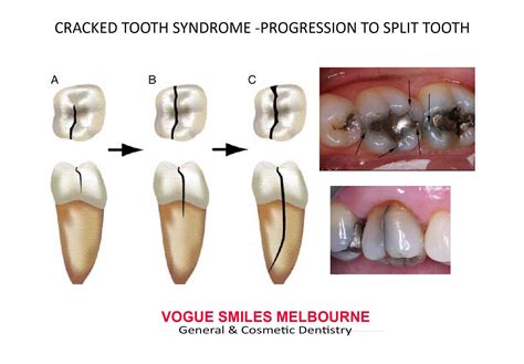 Cracked Tooth Cracked Tooth Syndrome