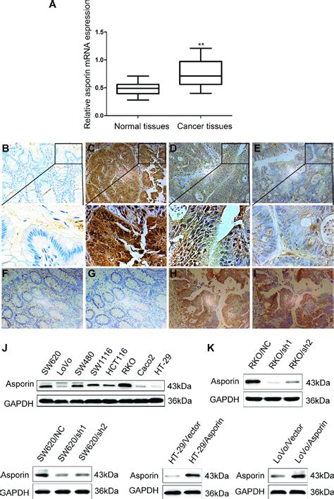 Expression Of Asporin In The CRC Tissues And Cell Lines 200 A