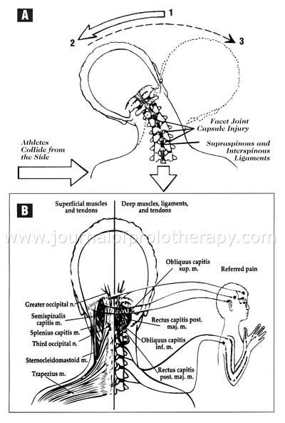 Non Operative Treatment Of Cervical Radiculopathy A Three Part Article