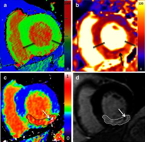 Multi Parametric Imaging In Acute Myocardial Infarction Basal Short