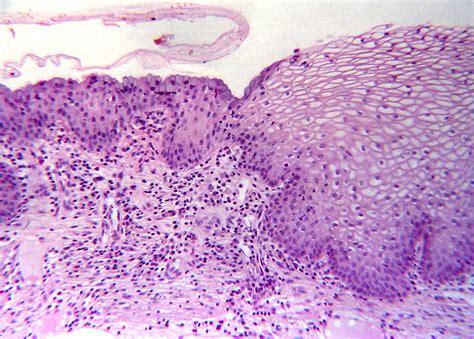 Histopathologie et cytopathologie du col utérin atlas numérique