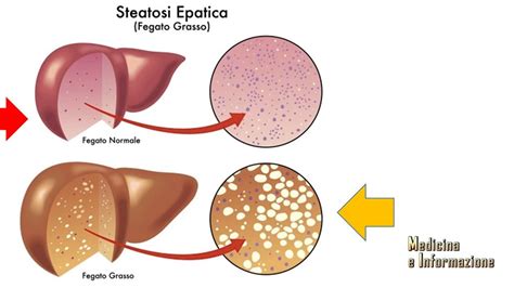 Steatosi Epatica Fegato Grasso Come Si Previene Come Si Combatte