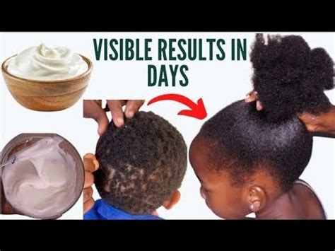 Visible Results In Days To Grow Back Alopecia Baldness Shedding Times