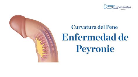 Enfermedad De Peyronie Doctores Especialistas Youtube