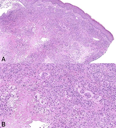 Necrobiotic Xanthogranuloma Mayo Clinic Proceedings