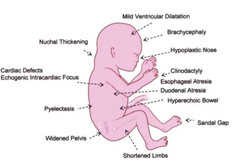 Module Fetal Chromosomal Abnormalities Flashcards Quizlet