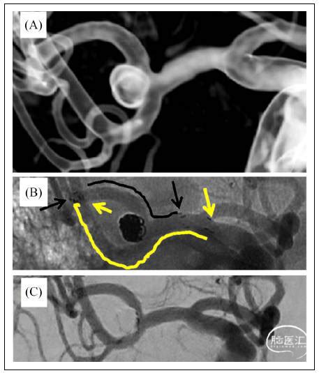 Atlas支架y型辅助弹簧圈栓塞颅内宽颈动脉瘤 脑医汇 神外资讯 神介资讯