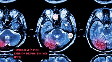 TOMOGRAFÍA POR EMISIÓN DE POSITRONES PET by Carlos Molina on Prezi