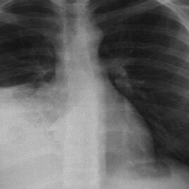 A Anterior Posterior Portable Plain Radiograph Of The Chest