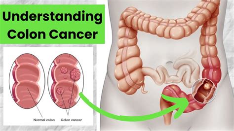 Understanding Colon Cancer Causes Symptoms And Treatment Options I