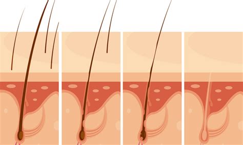 Qual O Tempo Para Os Fol Culos Fixarem Ap S O Transplante Capilar Dr