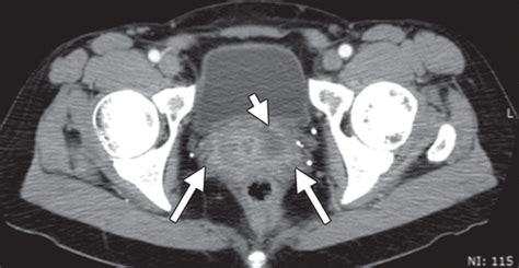 Pelvic Inflammatory Disease Multimodality Imaging Approach With