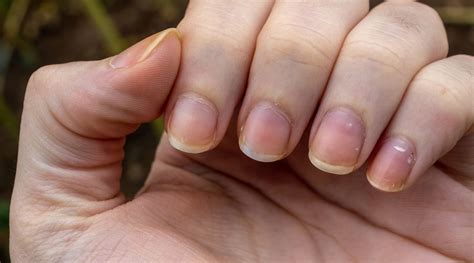 Gele Nagels Dit Kunnen De Oorzaken Zijn Max Vandaag