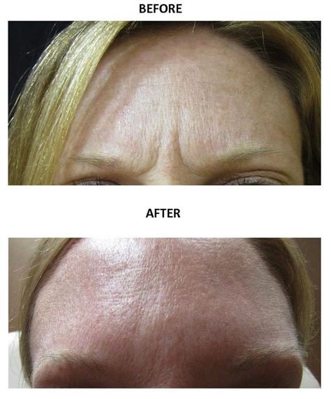 Before And After Botox® Photos The Medical Spa