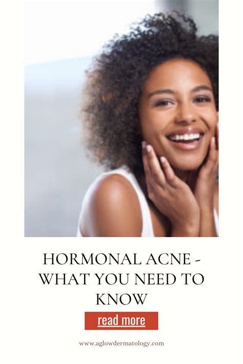 Hormonal Acne Causes Treatments And Prevention