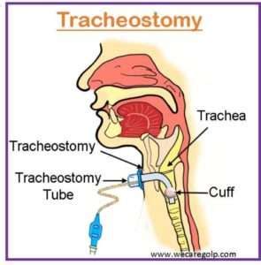 Tracheostomy Purposes Indications Risks We Care