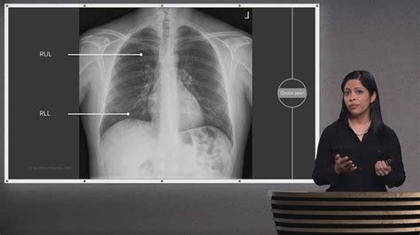 Pulmonary Radiology Corona Course Lecturio