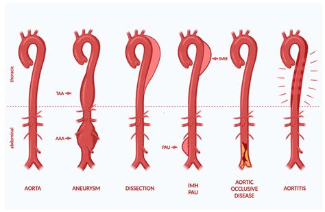 Cells Free Full Text Inflammasomes In The Pathophysiology Of Aortic