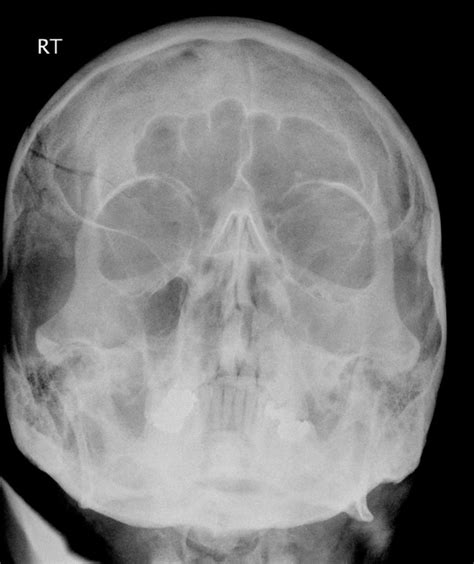 X Ray Of Skull Fracture Images