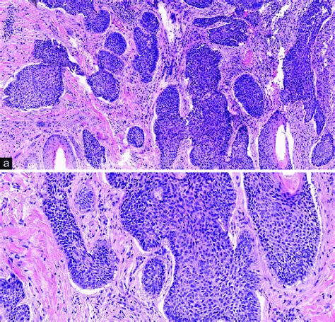 A And B Histopathology Showed Large Tumor Nodules Arising From The