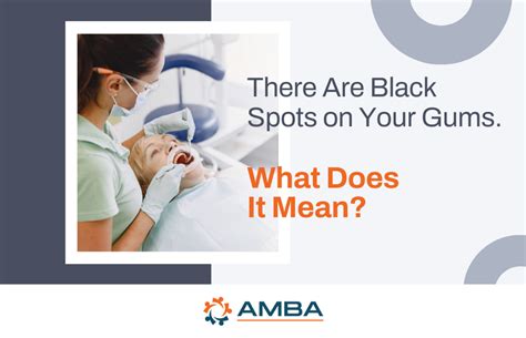 Common Causes Of Black Spots On Your Gums