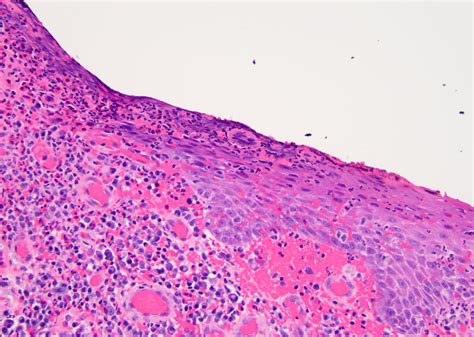 Pathology Outlines Herpes Simplex Virus