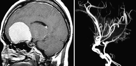 Olfactory Groove Meningiomas Pitfalls And Surgical Technique Neupsy Key