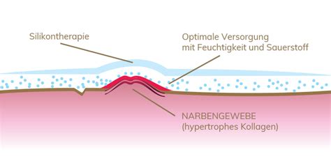 Narbenpflege Nach Einer Op Mit Silikonprodukten Lipoelastic At