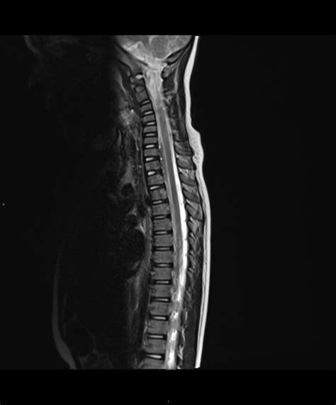 Polyostotic Fibrous Dysplasia Image Radiopaedia Org