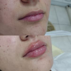 Conheça os benefícios do preenchimento labial DR Igor Ramos