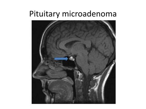 Ppt Pituitary Tumors Powerpoint Presentation Free Download Id 2178361