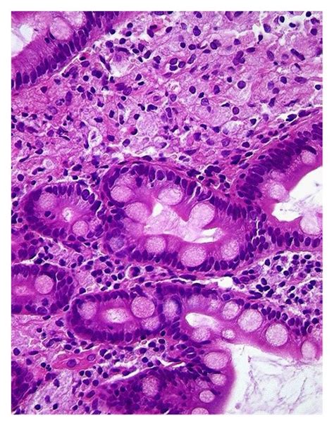 Whipples Disease Detailed View Of Macrophages In The Lamina Propria