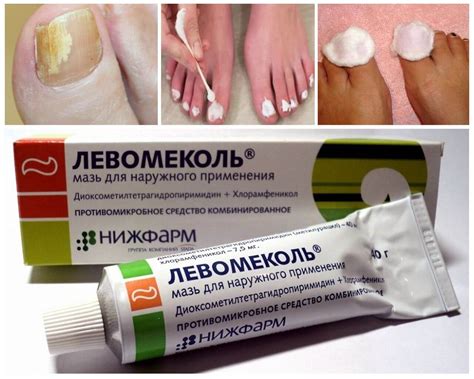 Грибок стопы и ногтей ног: эффективные мази для лечения