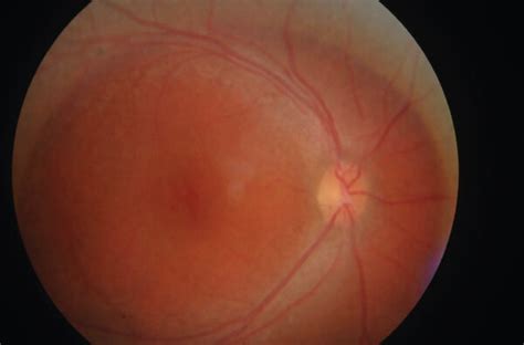 Fundus Photo Of The Right Eye Download Scientific Diagram