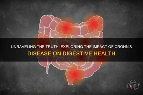 Unraveling The Truth Exploring The Impact Of Crohn S Disease On Digestive Health Shunvogue