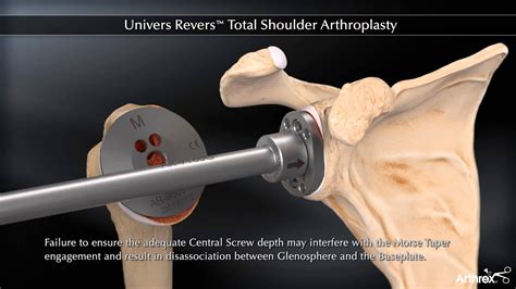 Univers Revers Total Shoulder Arthroplasty Youtube