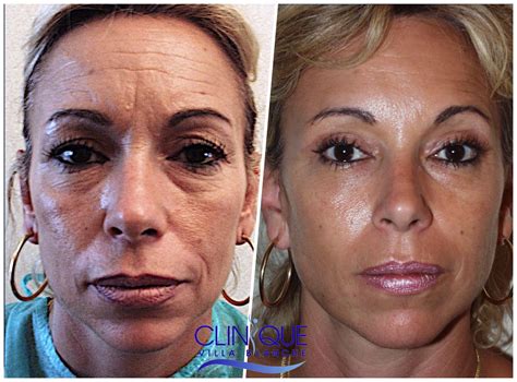 Lifting Visage Tunisie Chirurgie Esthtique Du Visage